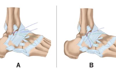 Broström-Gould Procedure: 5-Year Follow-Up