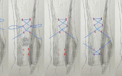 2MTIR vs PR for Achilles Tendon Rupture