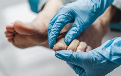 Long-Term Follow-Up Assesses Efficacy of Fosravuconazole for Onychomycosis in Elderly