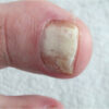 PCR Testing for Podiatric Nail & Skin Disorders