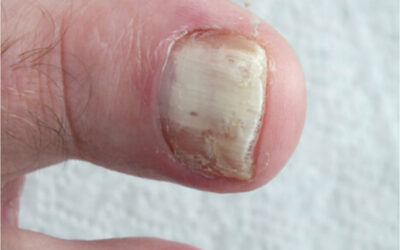 PCR Testing for Podiatric Nail & Skin Disorders