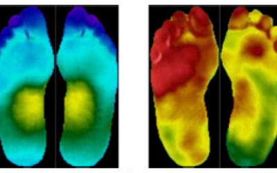 Can Thermography Predict Diabetic Foot Ulcer Risk in Patients with Diabetes?