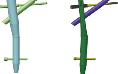 Solution Offers Hope for Treating Intertrochanteric Femur Fractures in the Elderly