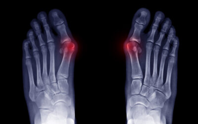 Minimally Invasive Bunion Surgery for Hallux Valgus: A Surgical Technique