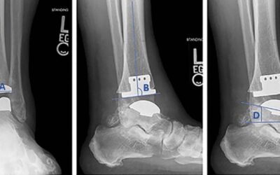Salto Talaris Fixed-Bearing Total Ankle Arthroplasty: 10-Yr Results