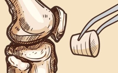 Synthetic Plugs Offer Alternative to Total Knee Replacements