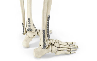 Ankle Plating System