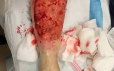 LER EXPO Conversations: FAQ – Diagnostic Miscues in Podiatric Dermatology