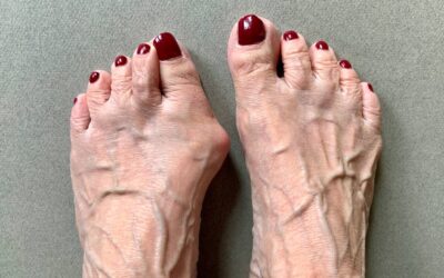 Hallux Valgus, Neuromuscular Control & Risk of Falls in Elderly