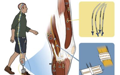 Sensory Neuroprosthesis Aids Stumble Recovery