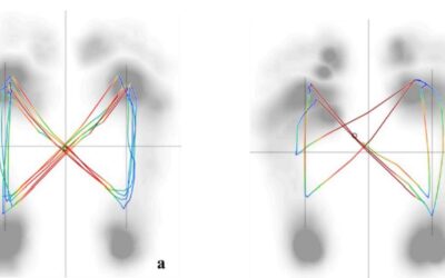 Plantar Pressure As Tool For Assessing Risk of Scoliosis