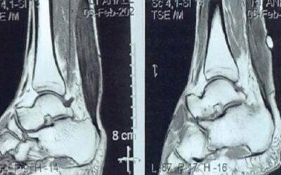 A Rare Case of Bilateral Xanthomatosis of the Achilles Tendon