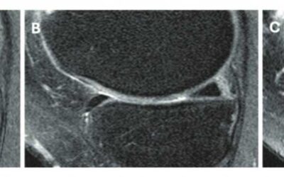 Intra-articular Knee Injections and KOA