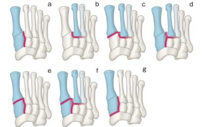 Optimizing Outcomes for Lisfranc Injuries
