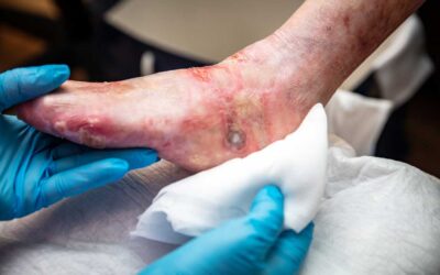 Ultrasonic Foot Stimulation Device Designed to Improve Circulation, Prevent Diabetes Complications