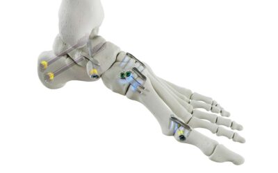 Nitinol Implant System for MTP Fusions, Lapidus Procedures