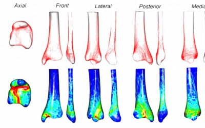 3D Mapping of Fracture Line Morphology of Pilon Fractures