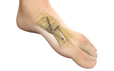 Minimally Invasive Bunion Fixation System