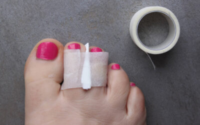Sports- and Recreation-Related Toe Fractures