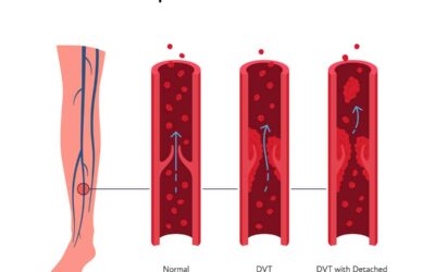 Biomarker Candidates to Predict DVT and Healing After Achilles Rupture