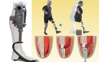 Osseointegrated Bionic Knee Can Restore Natural Movement