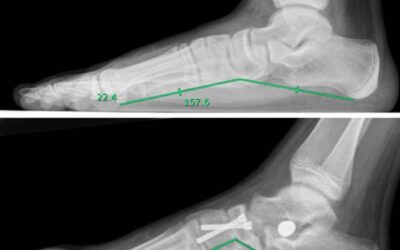 Positive Outcomes of Medial Arch-Hindfoot Reconstruction in Children