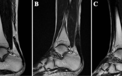 Freeze-Dried Platelet-Derived Concentrate for Achilles Tendon Rupture in Athletes