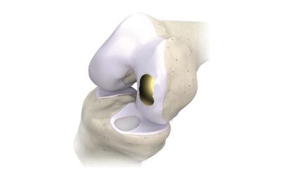 Knee Resurfacing System