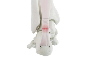 Achilles Repair System