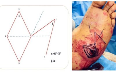 A Novel Reconstructive Approach for Plantar Charcot Midfoot Ulcer