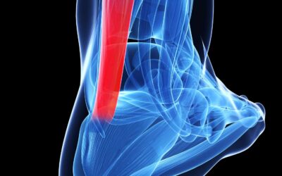 Anatomy of Plantaris Tendon and Management of Midportion Achilles Tendinopath