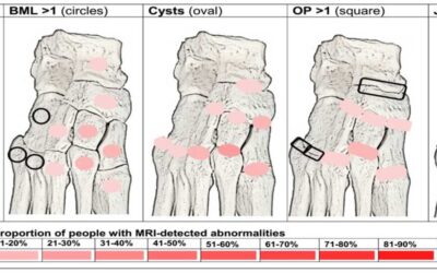 Study Compares Clinical and MRI Findings for Midfoot Pain