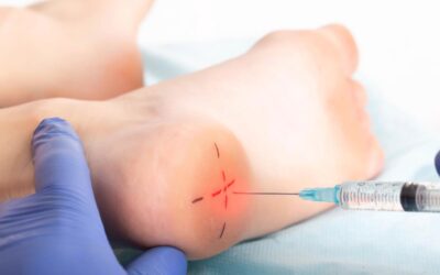Is Local Steroid Injection Predictive of Patient Response to Endoscopic Plantar Fascia Release