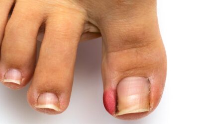 Partial Nail Avulsion With or Without Phenolization for Ingrown Toenails