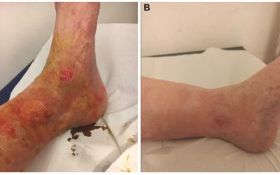 Ozone Successful Treatment of Venous Leg Ulcers and Diabetic Foot Ulcers