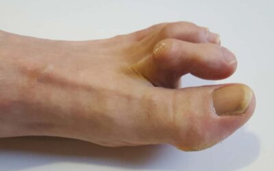 Long Term Outcomes After Flexor Tendon Tenotomy of the Diabetic Foot