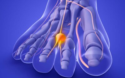 Optimized Nerve Management with Electrical Stim for Lower Extremity Neuroma