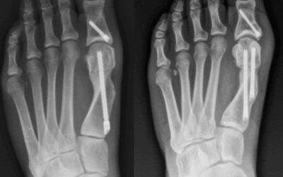 One Versus 2 Screw Fixation in MIS for Hallux Valgus