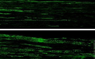 Possible Therapeutic Approach to Treat Diabetic Neuropathy Discovered