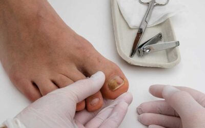 Cleveland Researchers Launch First Major Study to Address Onychomycosis