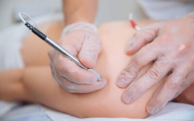 Percutaneous Electrolysis for Musculoskeletal Disorders in Rehab