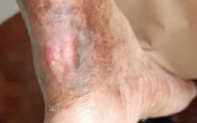 Innovative Sock Technology for the Prevention and Management of Decubitus Ulcers