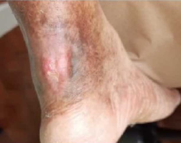 Innovative Sock Technology for the Prevention and Management of Decubitus Ulcers