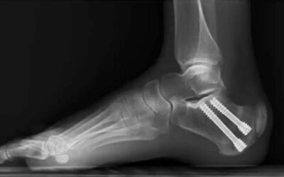 Minimally Invasive Zadek Osteotomy