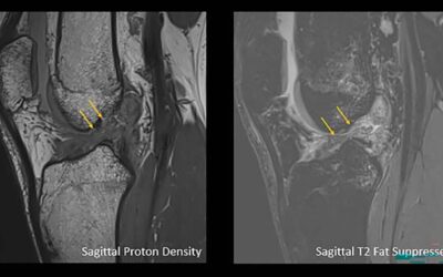 Study Reveals Injury Patterns Based on Gender, Age
