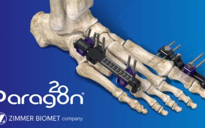 Foot and Ankle Fixation System Addresses Complex Small Bone Reconstruction