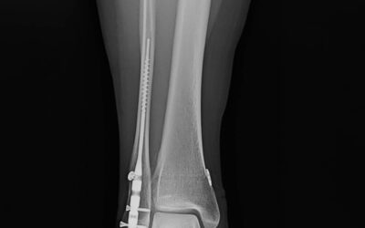 lerEXPO Highlights: Fibular Nails–Fad or New Standard?