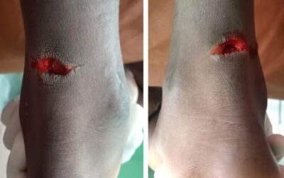 Bilateral Achilles Tendon Injury in a 14-Year-Old Adolescent: Case Report