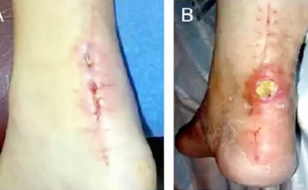 lerEXPO Highlights: Minimally Invasive Achilles Tendon Repair and Post-op Rehabilitation–How Quick Can We Go