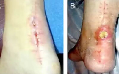 lerEXPO Highlights: Minimally Invasive Achilles Tendon Repair and Post-op Rehabilitation–How Quick Can We Go